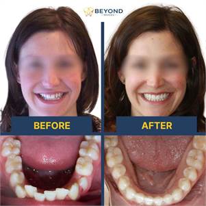 Invisalign in Surrey - Beyond Braces